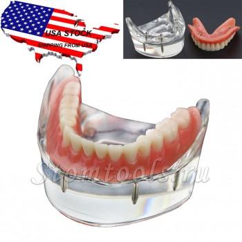 США зубные зубы модель 4 имплантаты демо Нижняя модель 6002 02