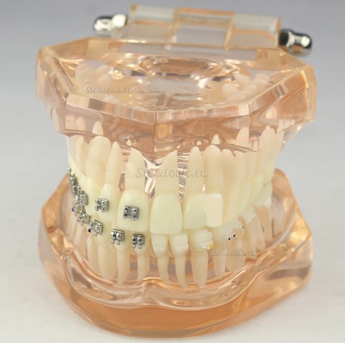 Стоматологическая модели ортодонтия с керамической скобки M3009
