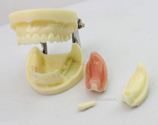 ENOVO Стоматологическая модели имплантов зубов с съемные зубов